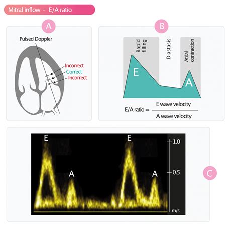 unable to assess diastolic function